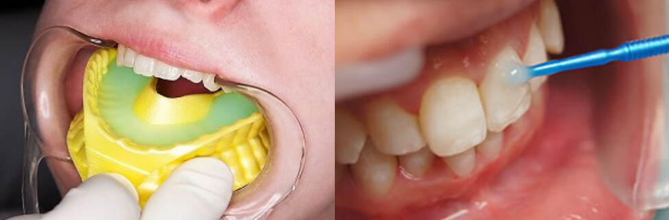 Aplicación de Flúor