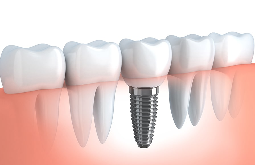 Implantes Dentales